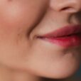 flacidez facial