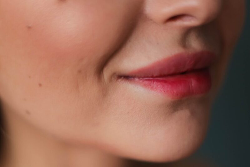 flacidez facial